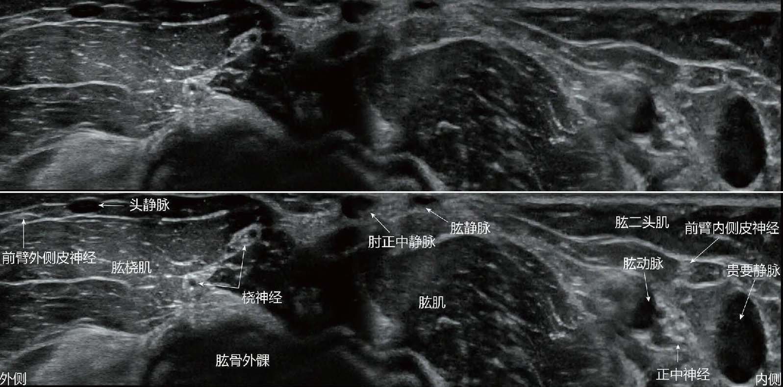 三、超聲引導(dǎo)正中神經(jīng)阻滯技術(shù)